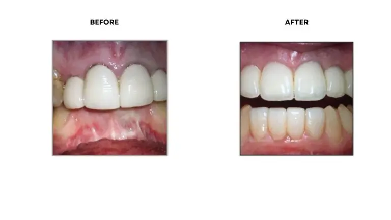 Dental Crowns and Bridges Rochester Hills, MI