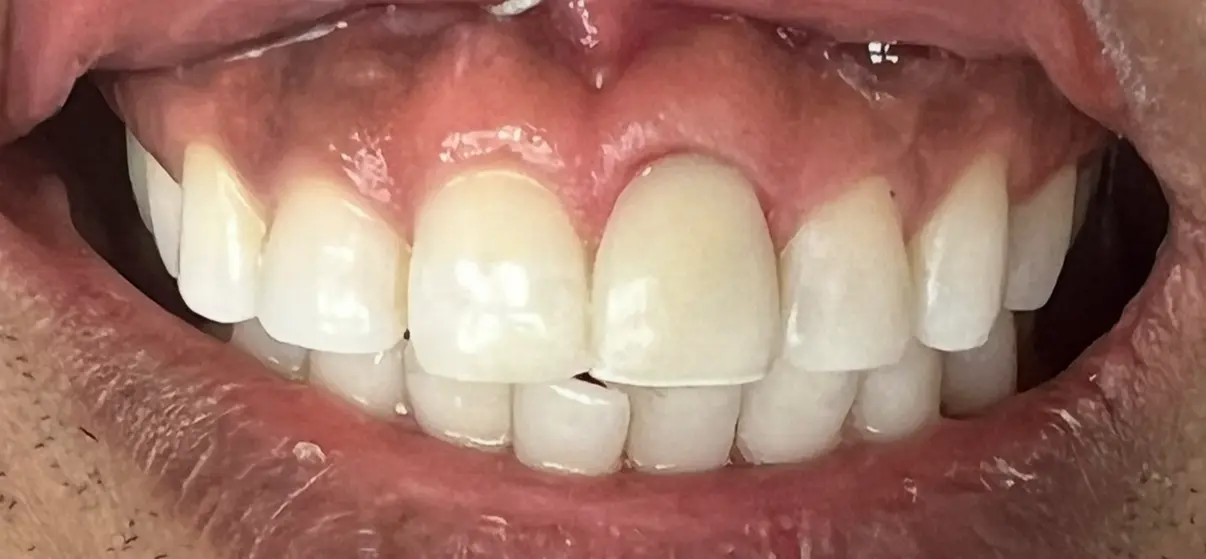 After treatment