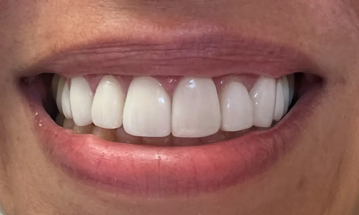 After treatment