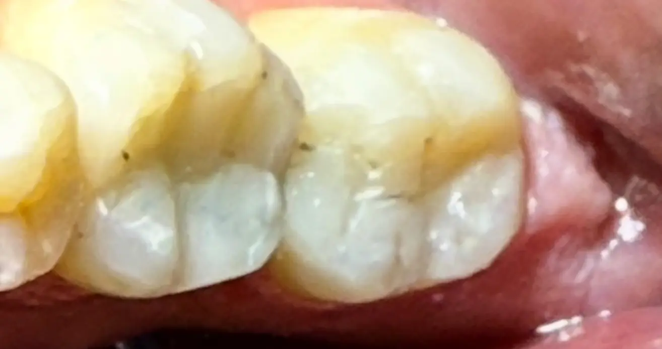 After treatment