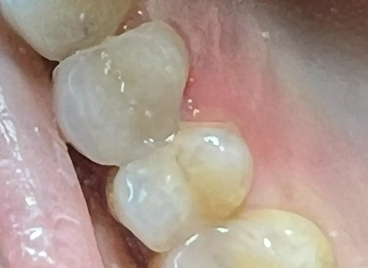 After treatment