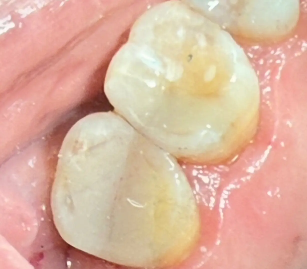 After treatment