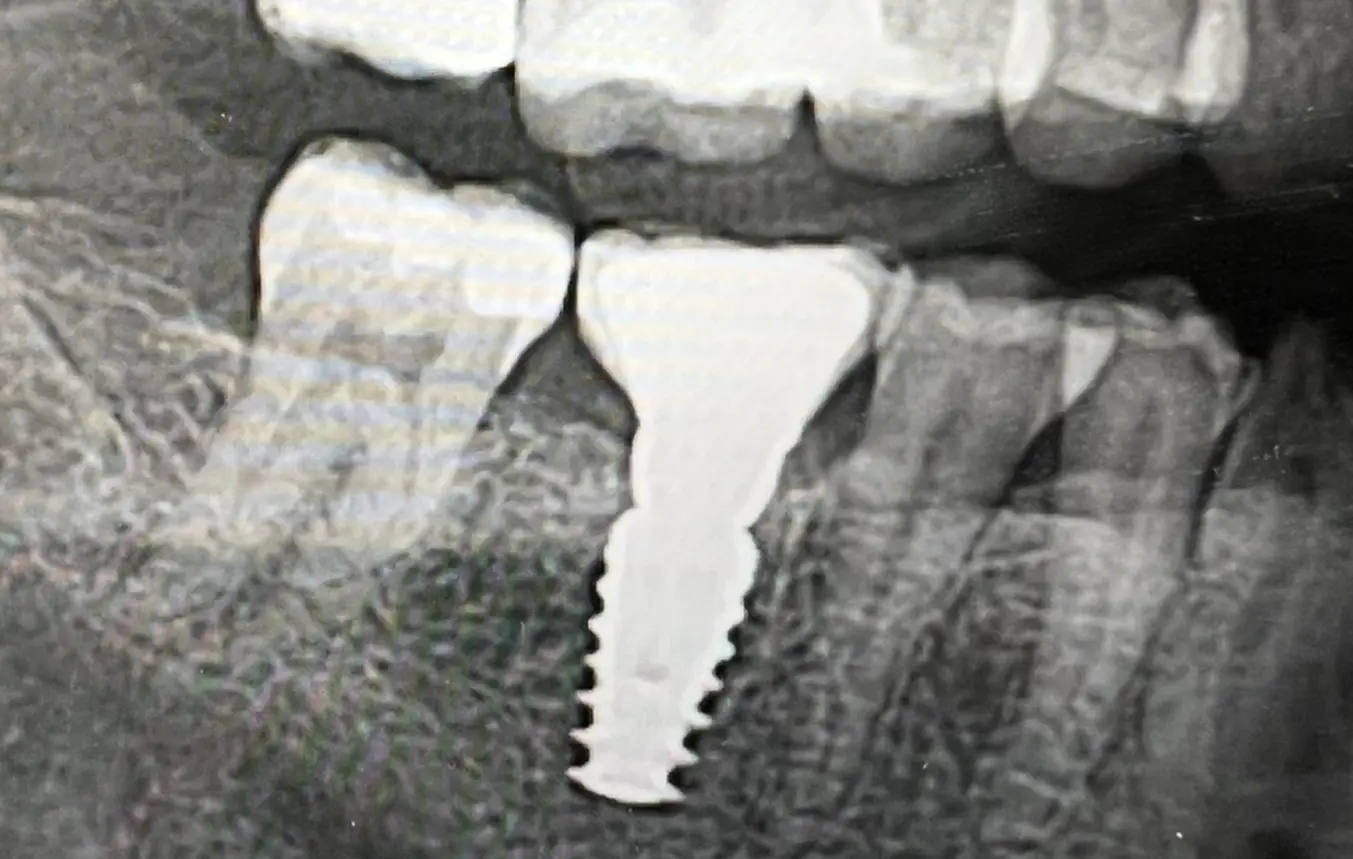 After treatment