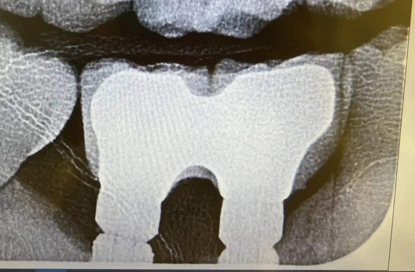 After treatment