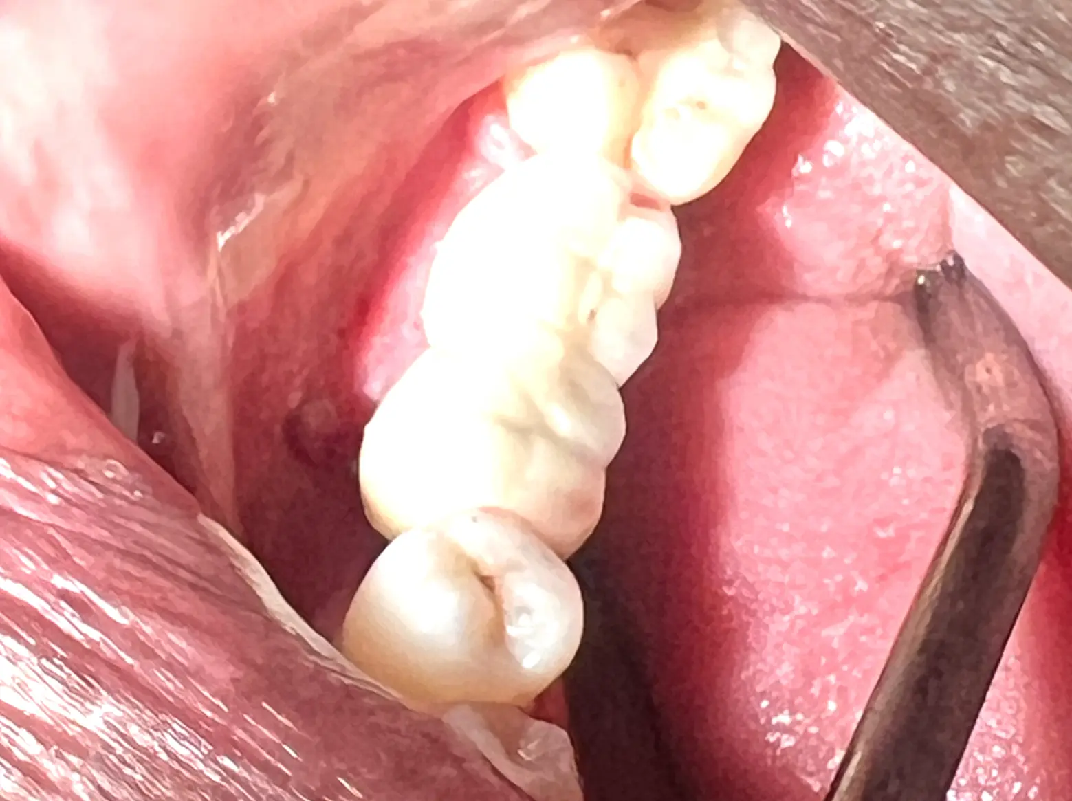 After treatment