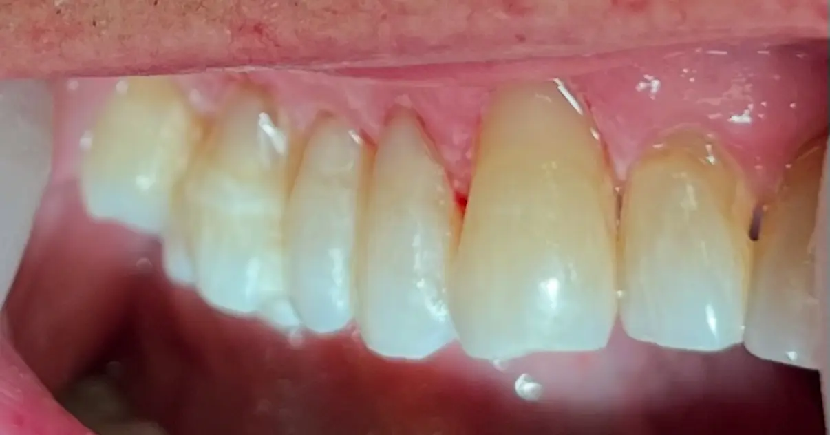 After treatment