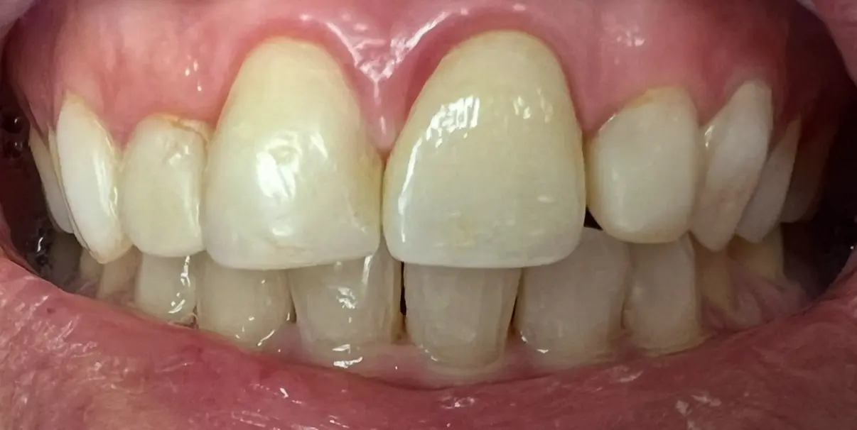 After treatment
