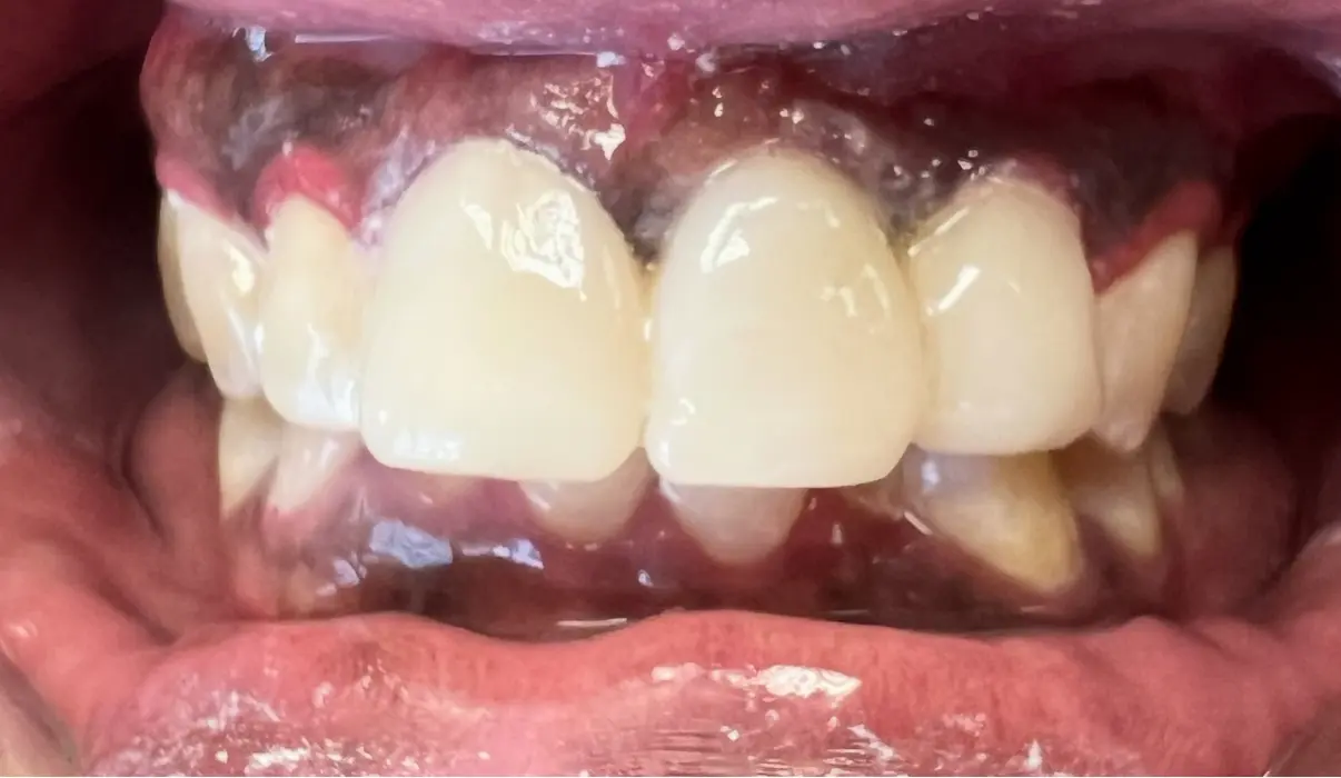 After treatment