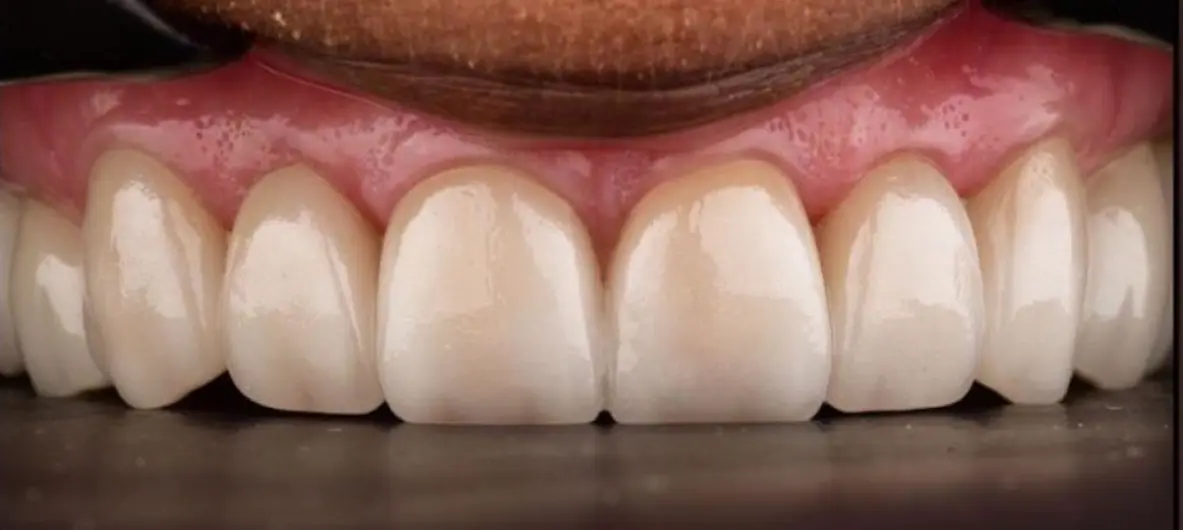 After treatment
