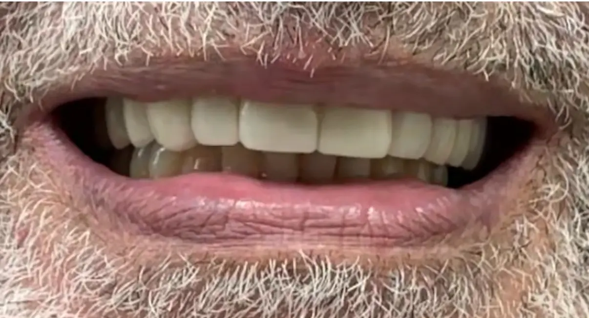After treatment