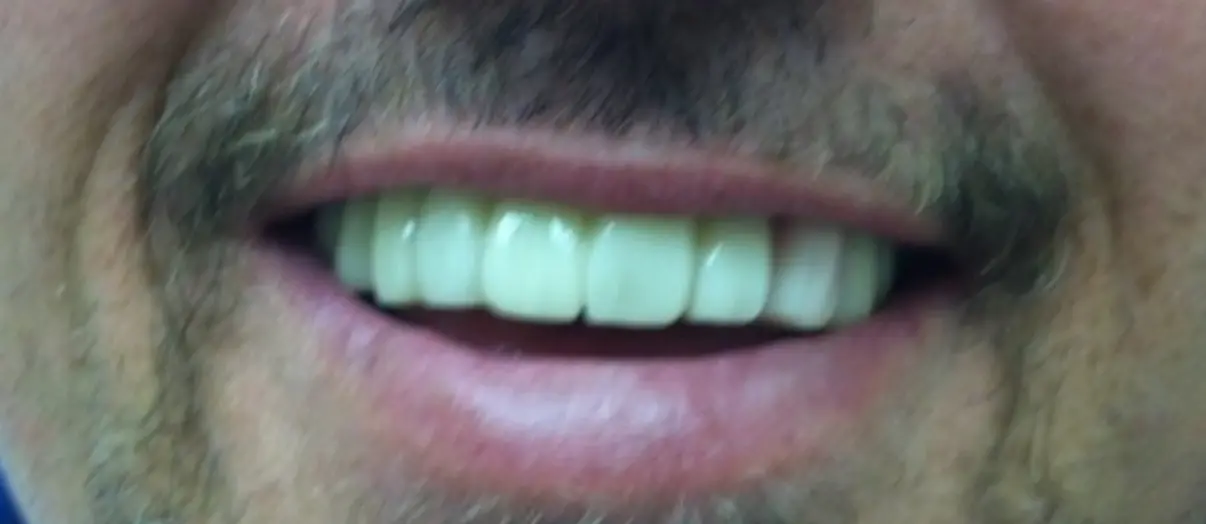 After treatment