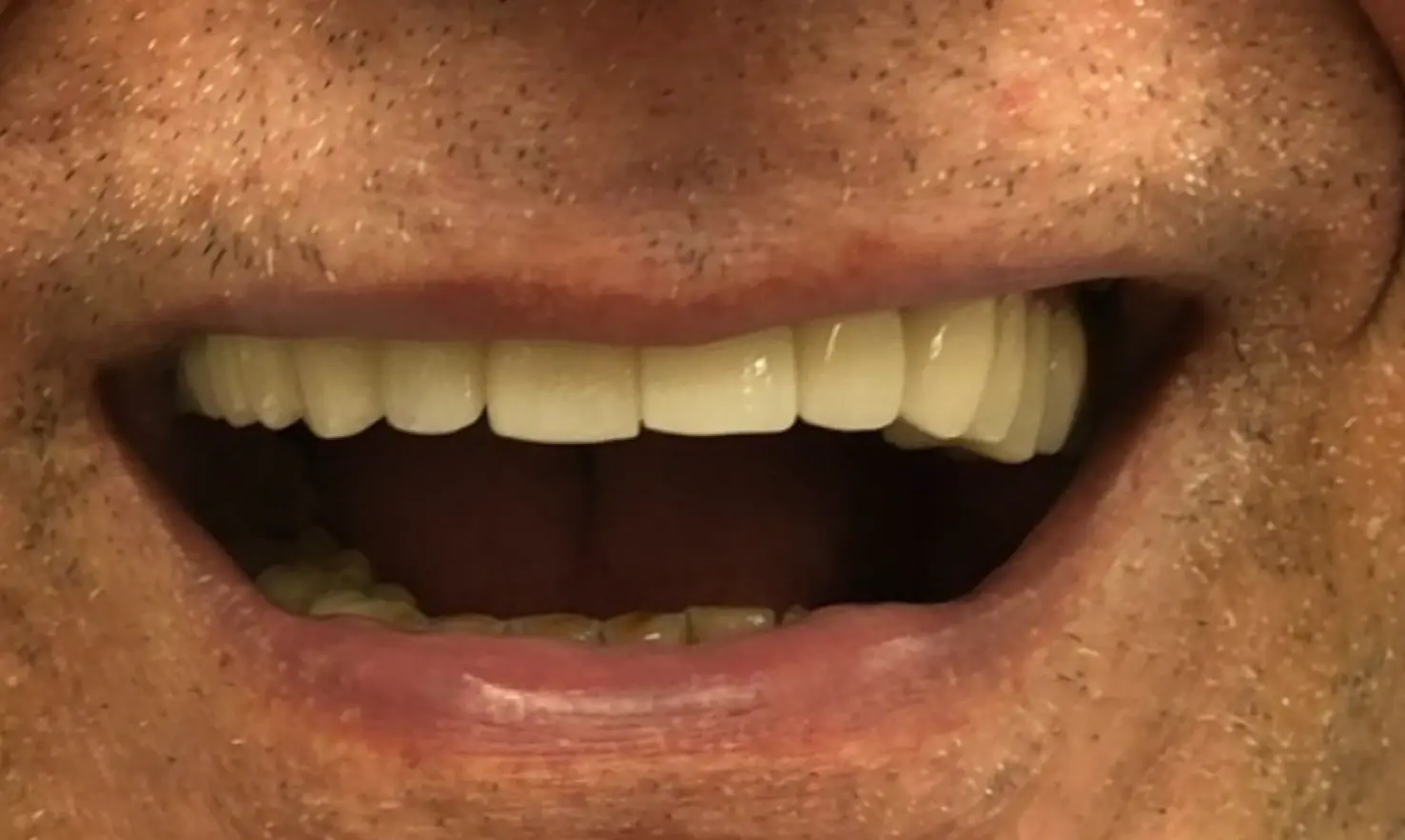 After treatment