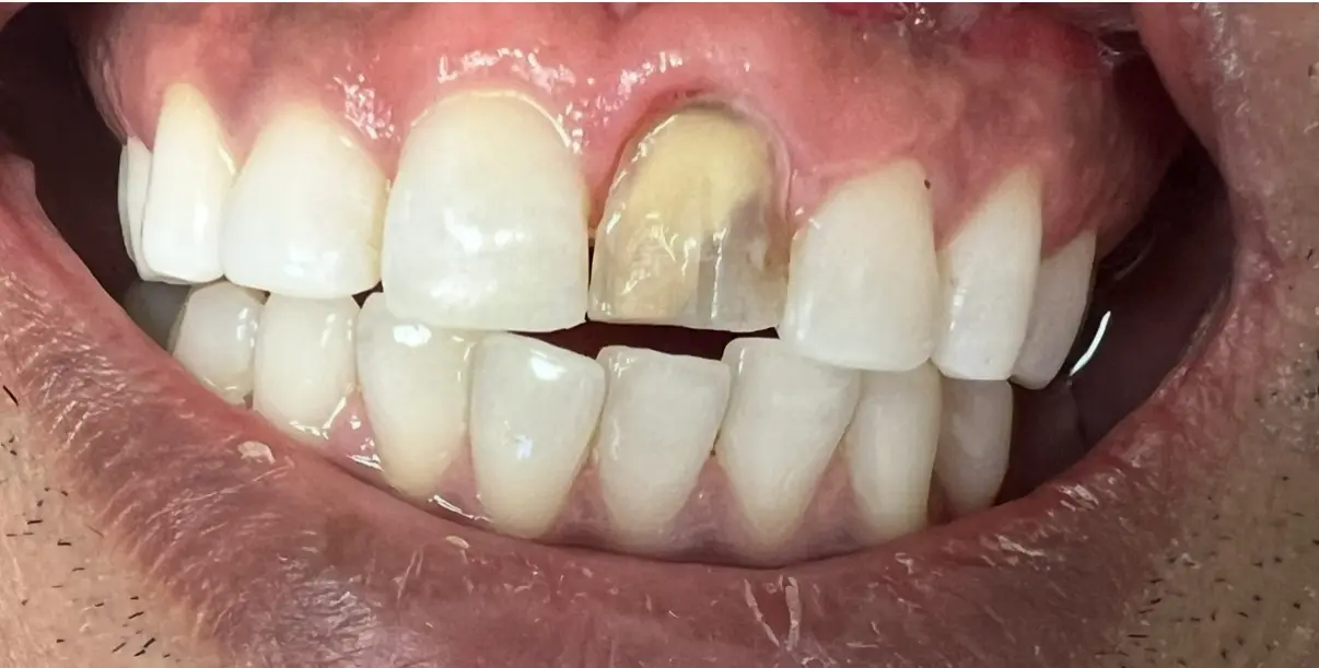 Before treatment