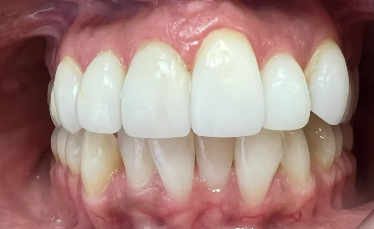 Before treatment