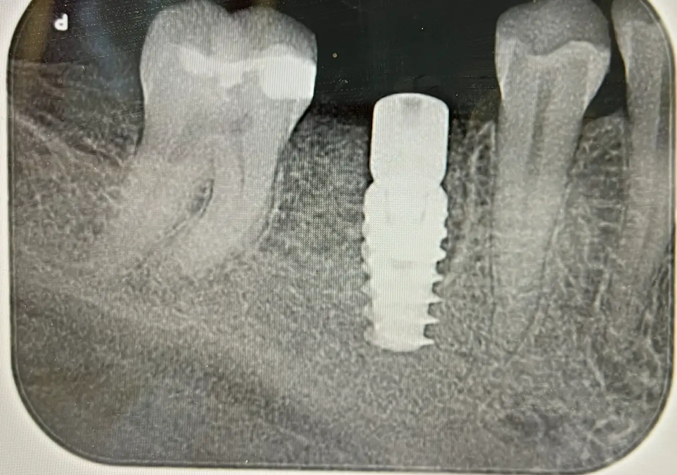 Before treatment