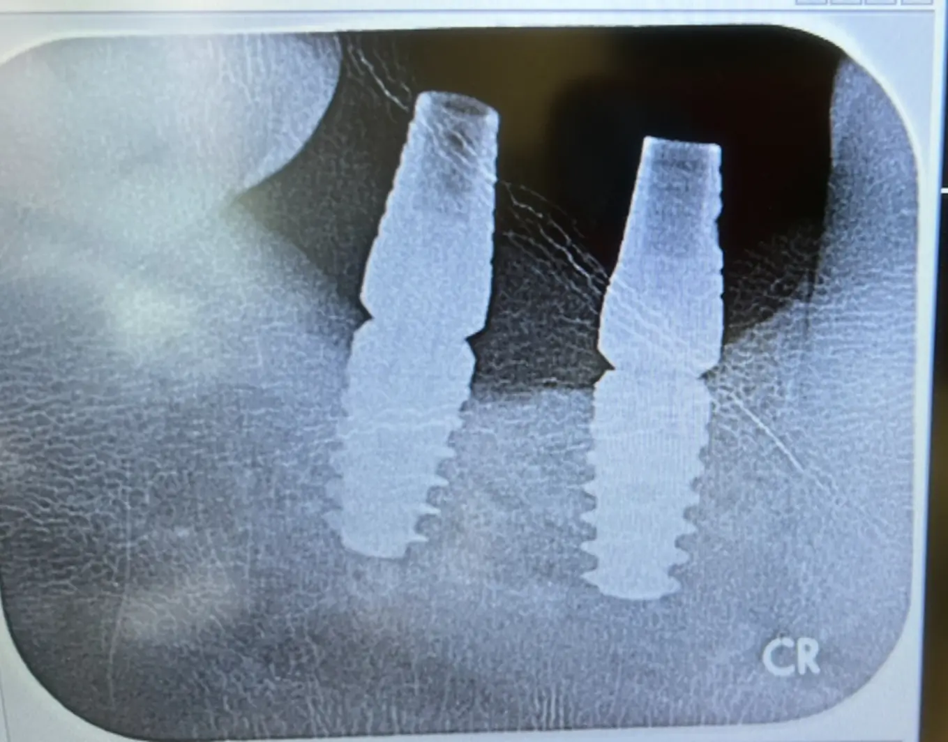 Before treatment