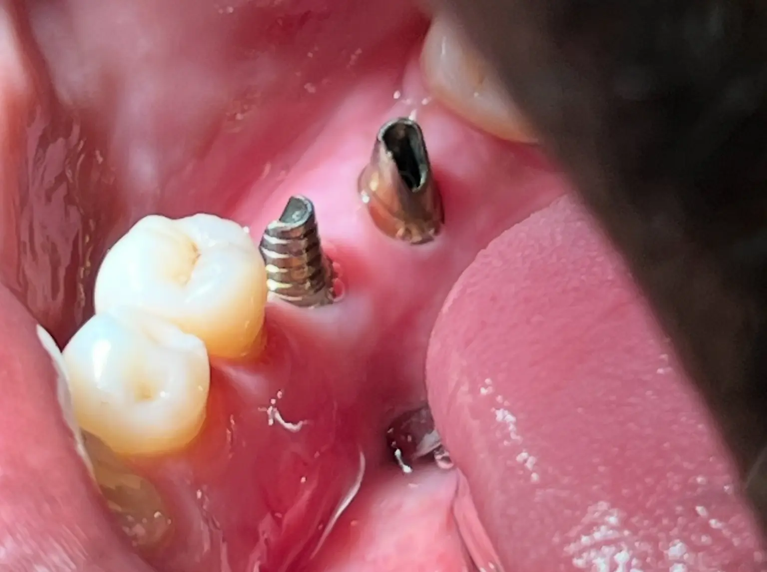 Before treatment