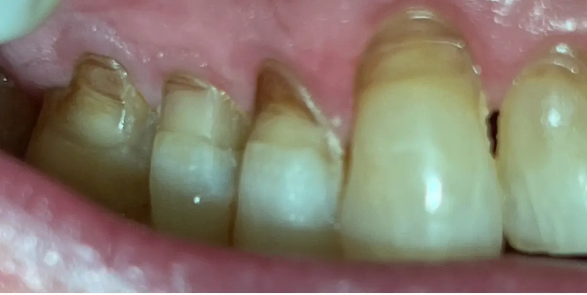 Before treatment