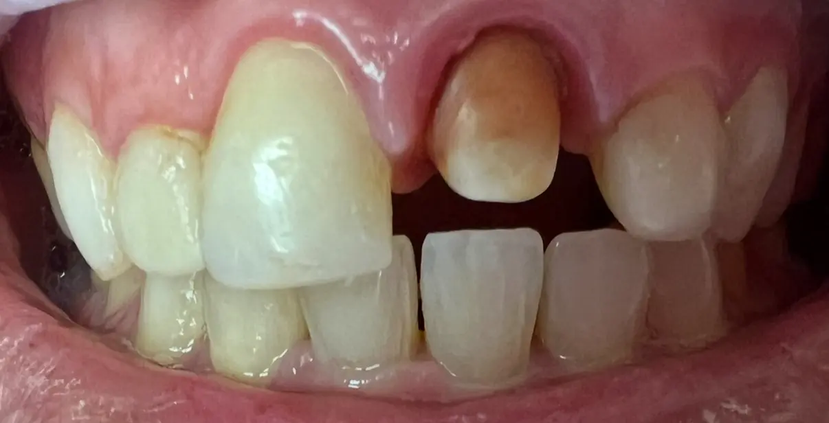 Before treatment