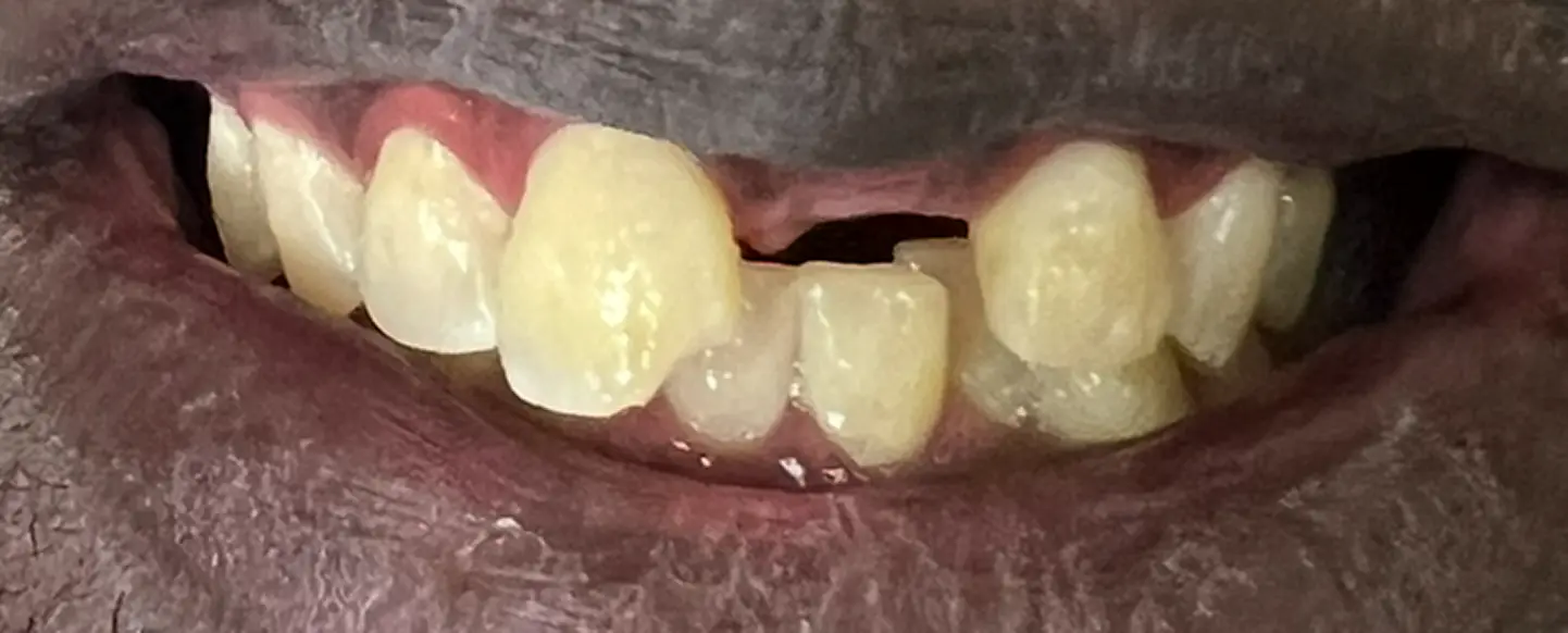 Before treatment