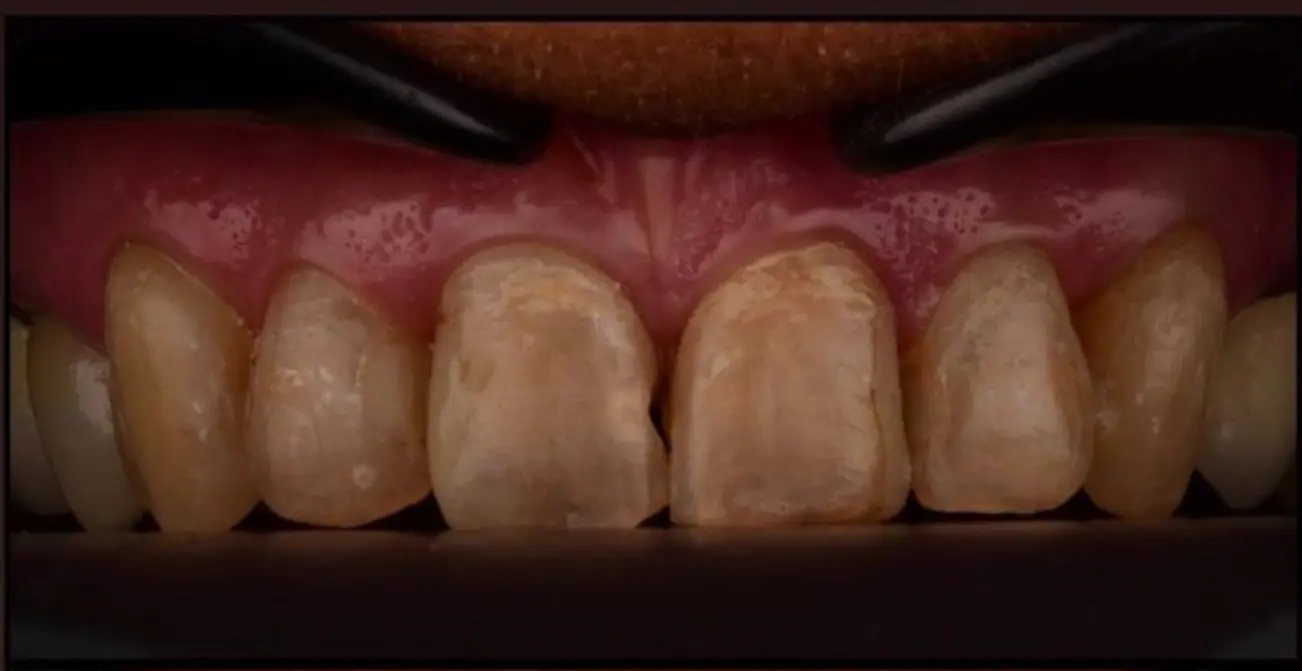 Before treatment