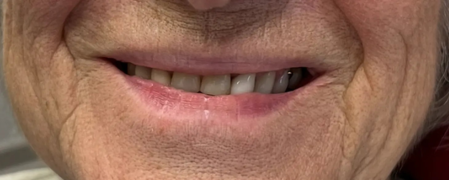 Before treatment