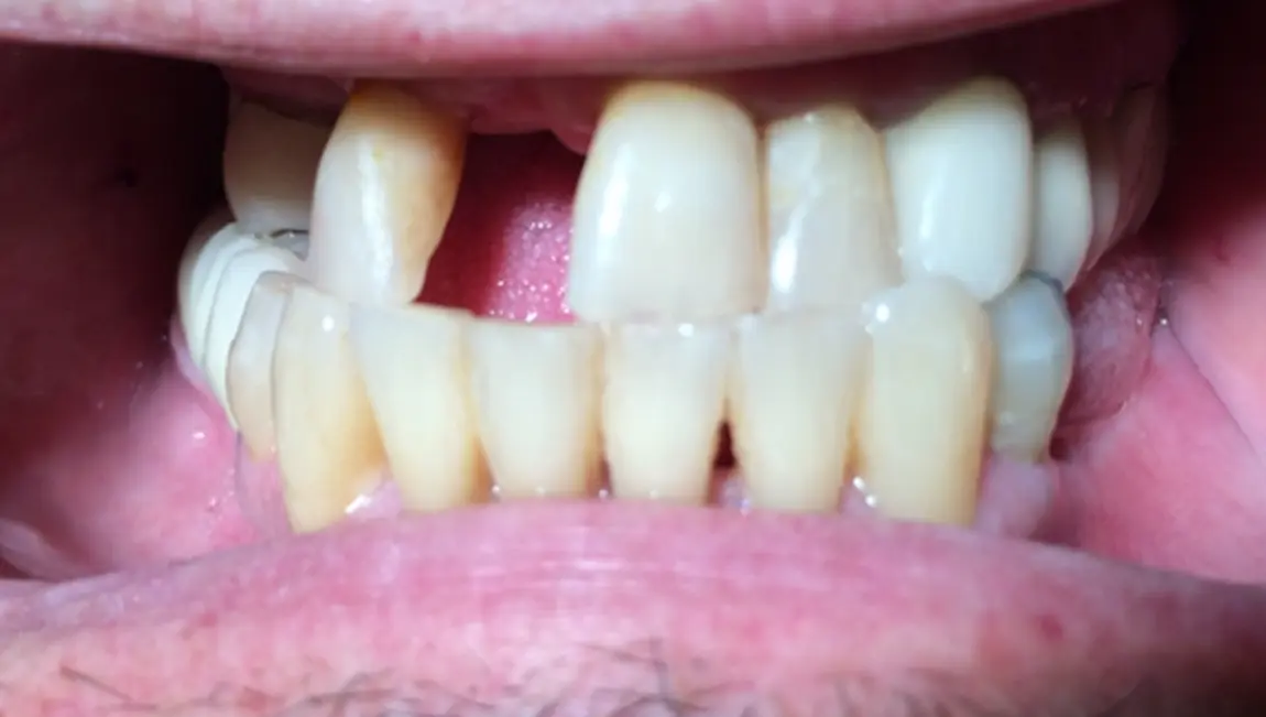 Before treatment