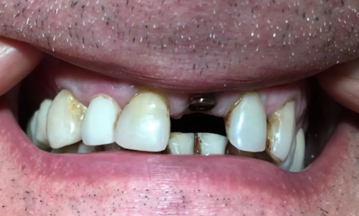 Before treatment