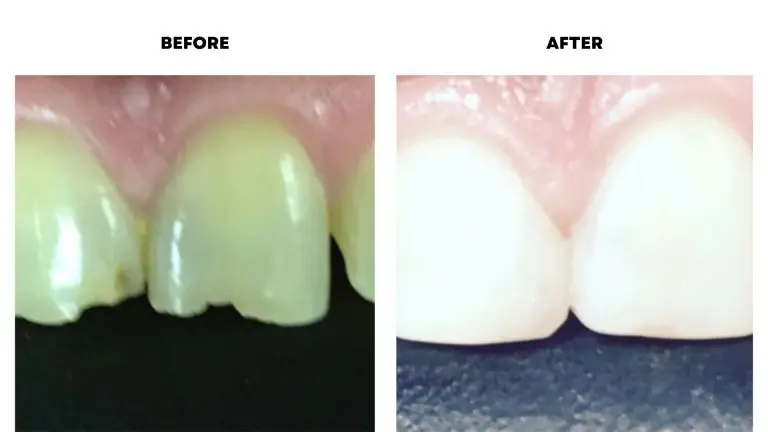 dental bonding before after image