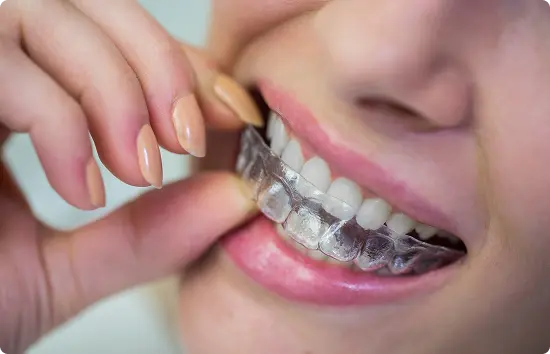 invisalign service