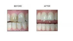 Dental Veneers Before After Rochester Hills Dentist