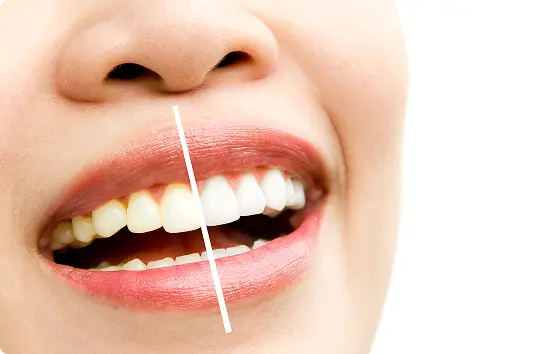 teeth whitening