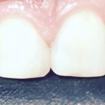 after dental bonding service Rochester Hills Dentist