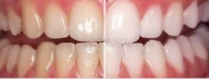 Rochester Hills Dentist before and after teeth whitening service