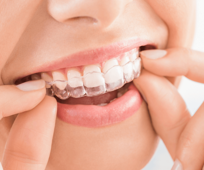 Invisalign® Braces Hackensack NJ