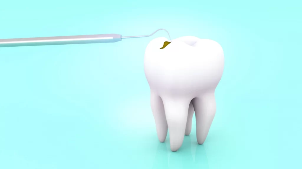 tooth cavity Hackensack