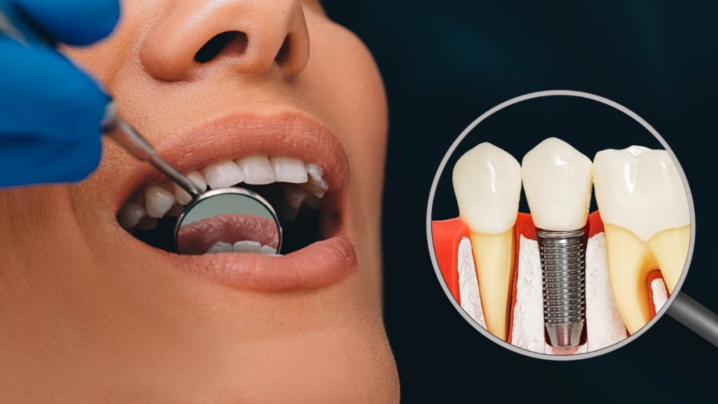 DENTAL IMPLANT SURGERY