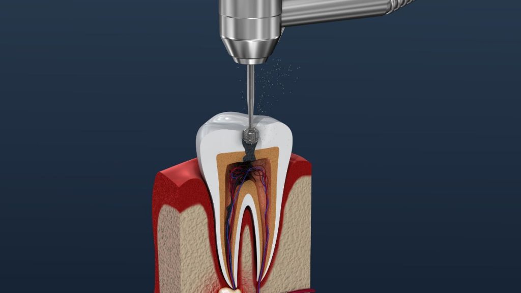 Root canal treatment