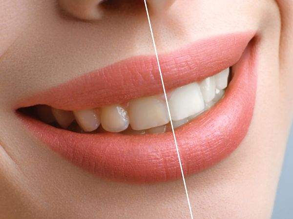 Teeth whitening in Rochester Hills