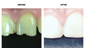 dental bonding before after image