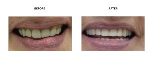 Complete Dentures