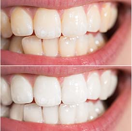 TEETH-WHITENING